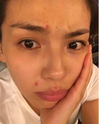 明星是怎么去痘痘的,明星祛痘秘籍大公开
